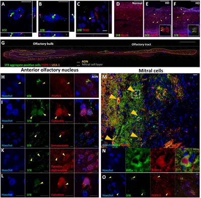 Huntingtin Aggregates in the Olfactory Bulb in Huntington’s Disease